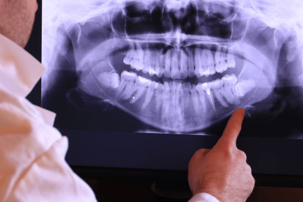 Best Emergency Tooth Extraction in Combes, TX