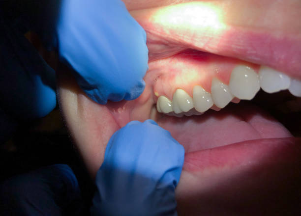 Best Emergency Treatment for Dental Infections or Abscesses in Combes, TX