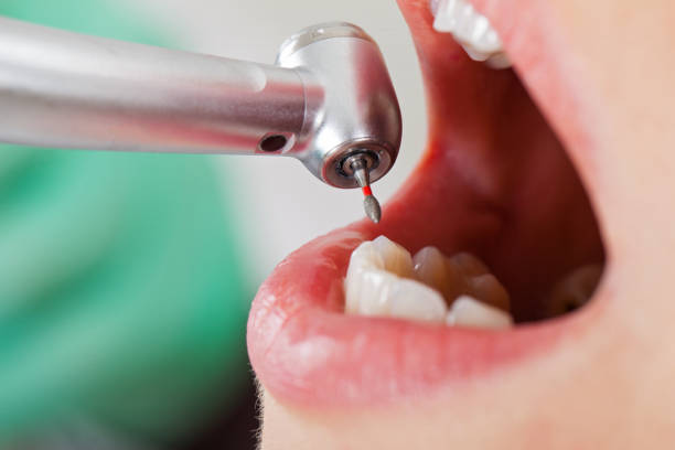Best Emergency Tooth Extraction in Combes, TX